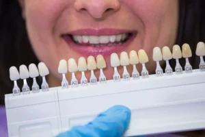 Veneers